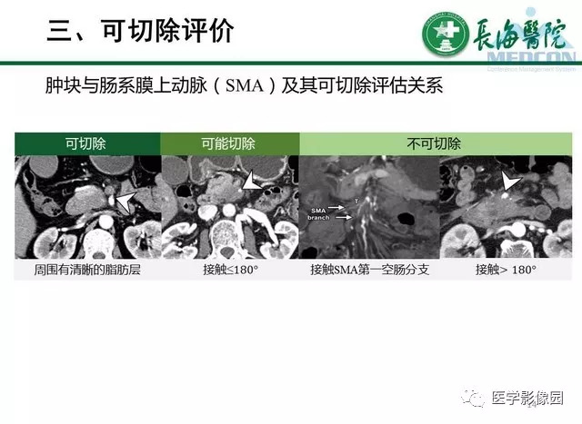【PPT】胰胰腺癌术前影像评估及规范化报告