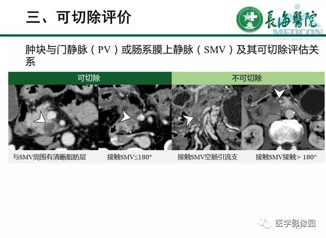 【PPT】胰胰腺癌术前影像评估及规范化报告