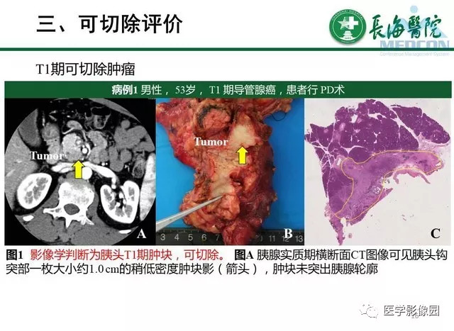 【PPT】胰胰腺癌术前影像评估及规范化报告