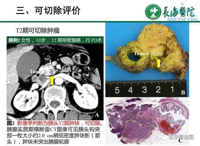 【PPT】胰胰腺癌术前影像评估及规范化报告