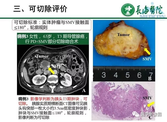 【PPT】胰胰腺癌术前影像评估及规范化报告