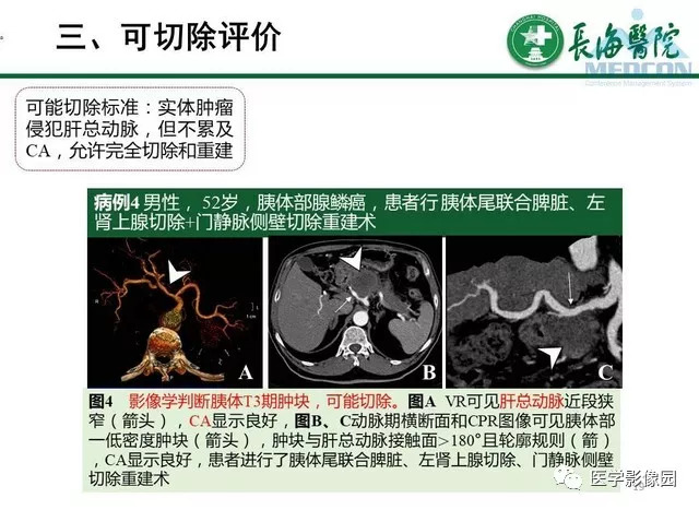 【PPT】胰胰腺癌术前影像评估及规范化报告