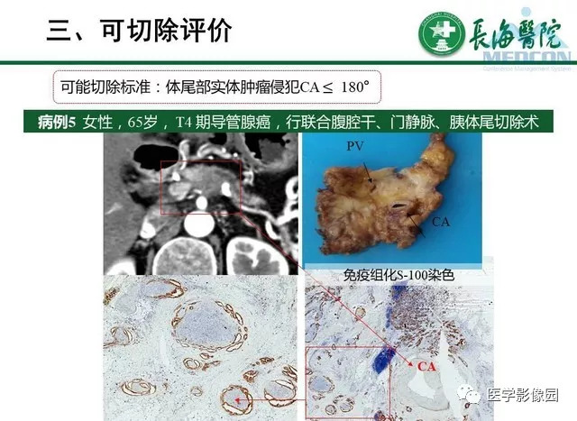 【PPT】胰胰腺癌术前影像评估及规范化报告