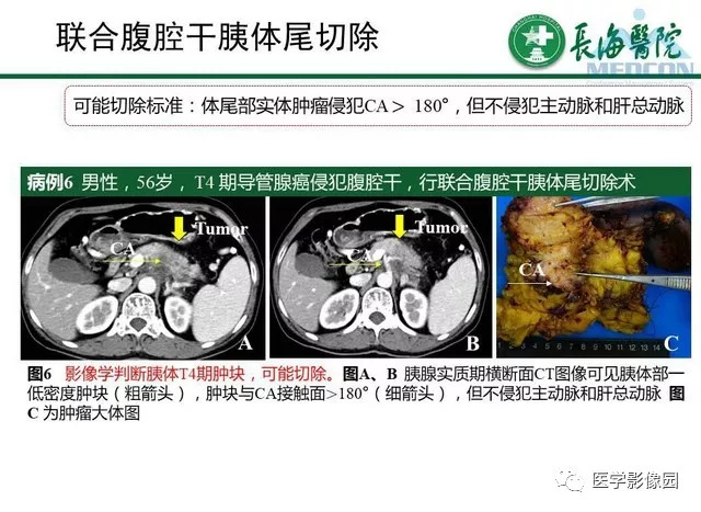 【PPT】胰胰腺癌术前影像评估及规范化报告