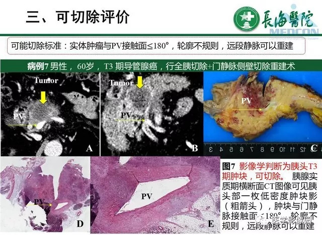 【PPT】胰胰腺癌术前影像评估及规范化报告