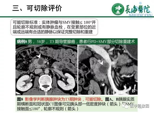 【PPT】胰胰腺癌术前影像评估及规范化报告