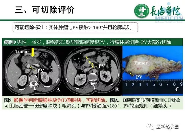 【PPT】胰胰腺癌术前影像评估及规范化报告