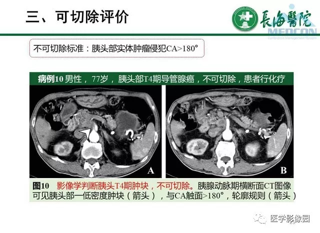 【PPT】胰胰腺癌术前影像评估及规范化报告