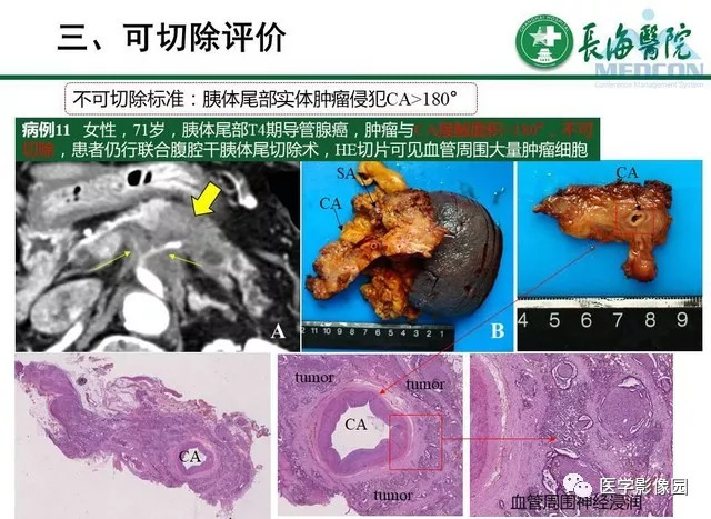【PPT】胰胰腺癌术前影像评估及规范化报告
