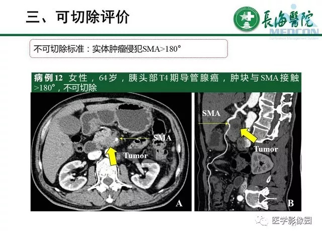 【PPT】胰胰腺癌术前影像评估及规范化报告