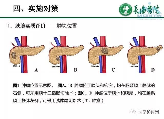 【PPT】胰胰腺癌术前影像评估及规范化报告