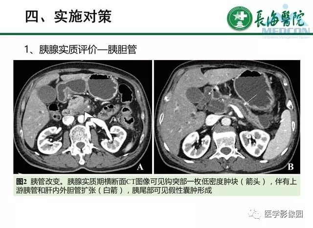 【PPT】胰胰腺癌术前影像评估及规范化报告