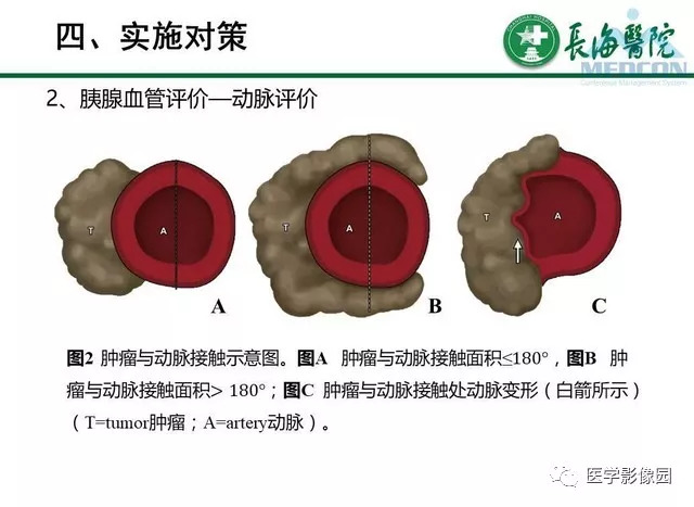 【PPT】胰胰腺癌术前影像评估及规范化报告