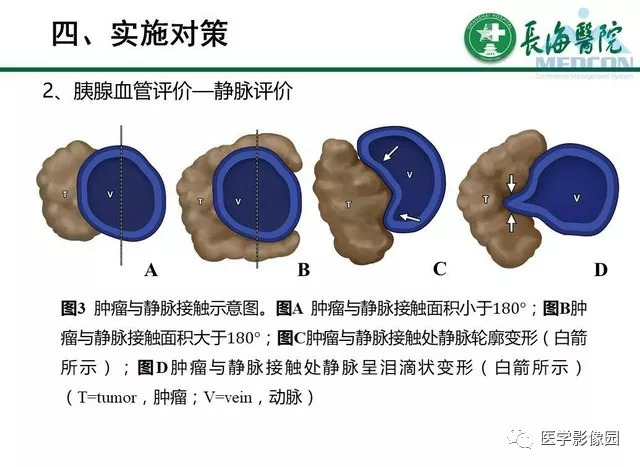 【PPT】胰胰腺癌术前影像评估及规范化报告