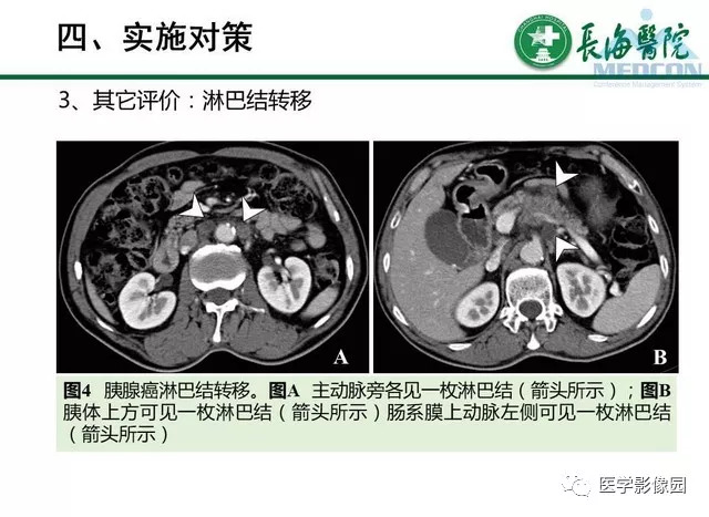 【PPT】胰胰腺癌术前影像评估及规范化报告