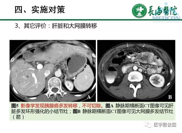 【PPT】胰胰腺癌术前影像评估及规范化报告