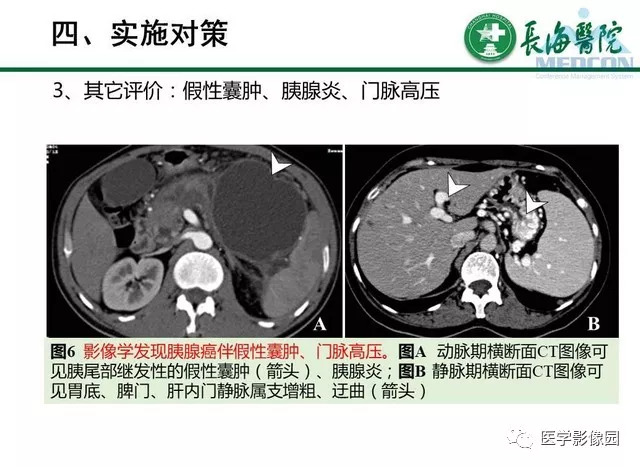 【PPT】胰胰腺癌术前影像评估及规范化报告