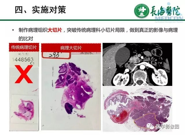 【PPT】胰胰腺癌术前影像评估及规范化报告