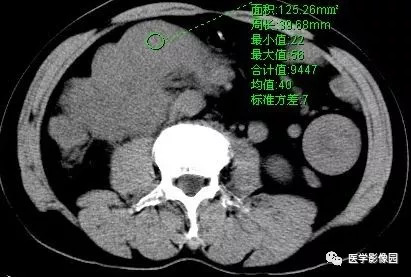 【病例】肠系膜淋巴瘤1例CT影像表现 【病例】肠系膜淋巴瘤1例CT影像表现