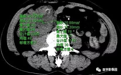 【病例】肠系膜淋巴瘤1例CT影像表现 【病例】肠系膜淋巴瘤1例CT影像表现