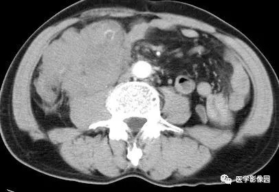 【病例】肠系膜淋巴瘤1例CT影像表现 【病例】肠系膜淋巴瘤1例CT影像表现