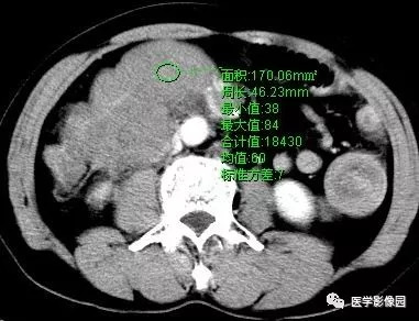 【病例】肠系膜淋巴瘤1例CT影像表现 【病例】肠系膜淋巴瘤1例CT影像表现