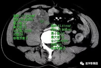 【病例】肠系膜淋巴瘤1例CT影像表现 【病例】肠系膜淋巴瘤1例CT影像表现