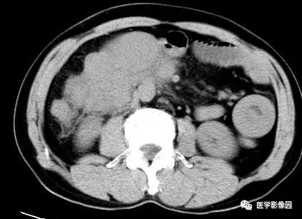 【病例】肠系膜淋巴瘤1例CT影像表现 【病例】肠系膜淋巴瘤1例CT影像表现