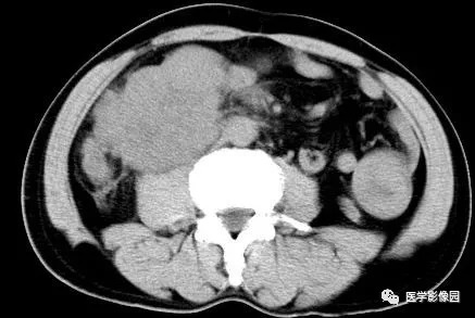 【病例】肠系膜淋巴瘤1例CT影像表现 【病例】肠系膜淋巴瘤1例CT影像表现