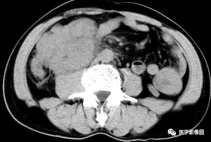 【病例】肠系膜淋巴瘤1例CT影像表现 【病例】肠系膜淋巴瘤1例CT影像表现
