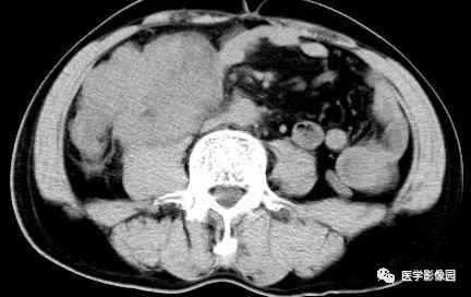 【病例】肠系膜淋巴瘤1例CT影像表现 【病例】肠系膜淋巴瘤1例CT影像表现