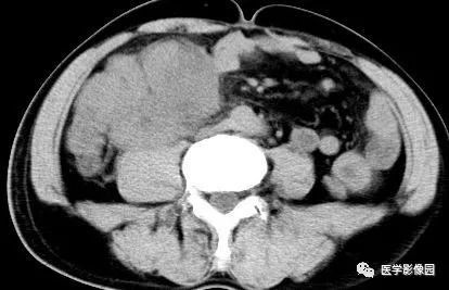 【病例】肠系膜淋巴瘤1例CT影像表现 【病例】肠系膜淋巴瘤1例CT影像表现