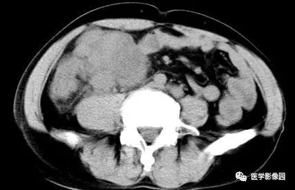 【病例】肠系膜淋巴瘤1例CT影像表现 【病例】肠系膜淋巴瘤1例CT影像表现