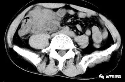 【病例】肠系膜淋巴瘤1例CT影像表现 【病例】肠系膜淋巴瘤1例CT影像表现