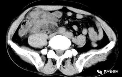 【病例】肠系膜淋巴瘤1例CT影像表现 【病例】肠系膜淋巴瘤1例CT影像表现