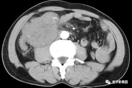 【病例】肠系膜淋巴瘤1例CT影像表现 【病例】肠系膜淋巴瘤1例CT影像表现