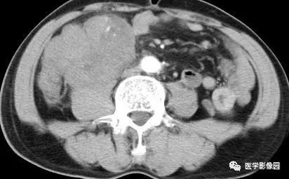 【病例】肠系膜淋巴瘤1例CT影像表现 【病例】肠系膜淋巴瘤1例CT影像表现