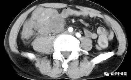 【病例】肠系膜淋巴瘤1例CT影像表现 【病例】肠系膜淋巴瘤1例CT影像表现