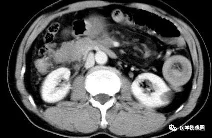【病例】肠系膜淋巴瘤1例CT影像表现 【病例】肠系膜淋巴瘤1例CT影像表现