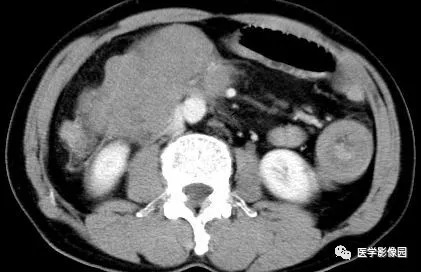 【病例】肠系膜淋巴瘤1例CT影像表现 【病例】肠系膜淋巴瘤1例CT影像表现