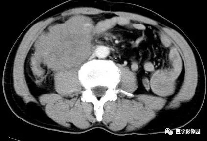 【病例】肠系膜淋巴瘤1例CT影像表现 【病例】肠系膜淋巴瘤1例CT影像表现