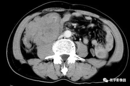 【病例】肠系膜淋巴瘤1例CT影像表现 【病例】肠系膜淋巴瘤1例CT影像表现