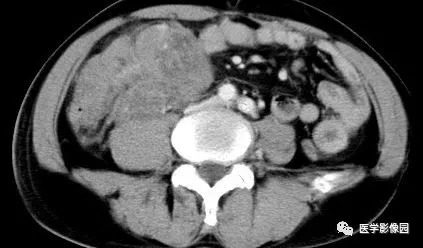 【病例】肠系膜淋巴瘤1例CT影像表现 【病例】肠系膜淋巴瘤1例CT影像表现