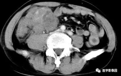 【病例】肠系膜淋巴瘤1例CT影像表现 【病例】肠系膜淋巴瘤1例CT影像表现