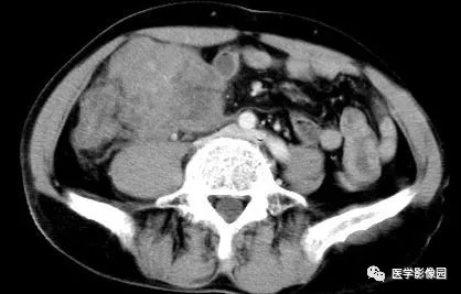 【病例】肠系膜淋巴瘤1例CT影像表现 【病例】肠系膜淋巴瘤1例CT影像表现