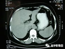 【病例】脾脏组织胞浆菌性肉芽肿1例CT 【病例】脾脏组织胞浆菌性肉芽肿1例CT