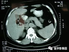 【病例】脾脏组织胞浆菌性肉芽肿1例CT 【病例】脾脏组织胞浆菌性肉芽肿1例CT