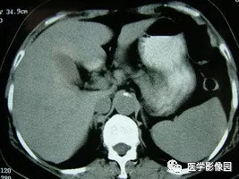 【病例】脾脏组织胞浆菌性肉芽肿1例CT 【病例】脾脏组织胞浆菌性肉芽肿1例CT