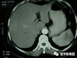 【病例】脾脏组织胞浆菌性肉芽肿1例CT 【病例】脾脏组织胞浆菌性肉芽肿1例CT
