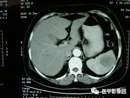 【病例】脾脏组织胞浆菌性肉芽肿1例CT 【病例】脾脏组织胞浆菌性肉芽肿1例CT